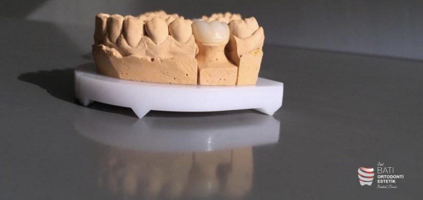 Dental Crown 2